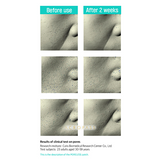 Poreless Microneedle Bubble Pack (2 Cleansing Pouch + 4 Patches)